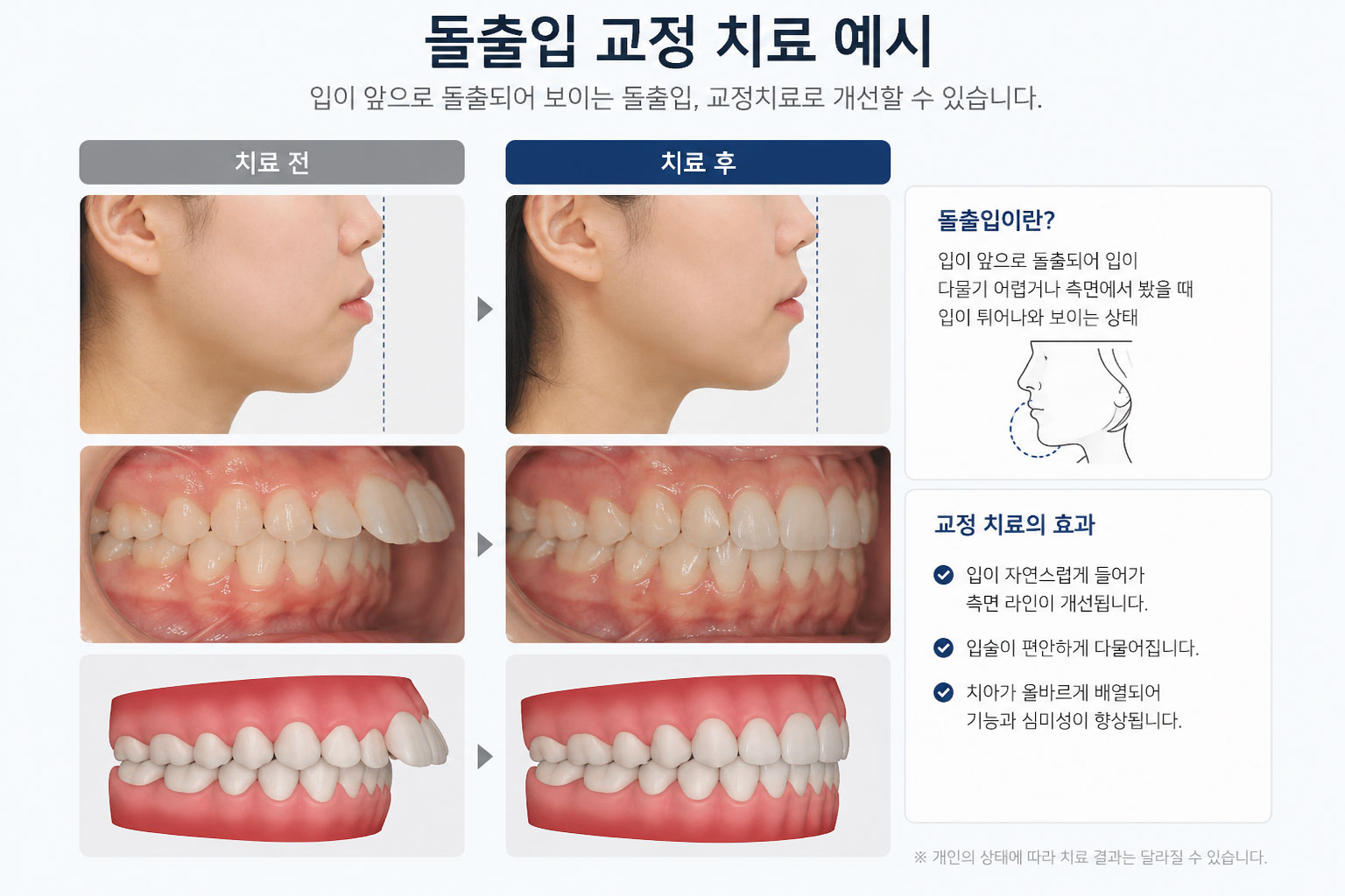 강남 돌출입 교정 예시 — 입과 치아가 앞으로 돌출된 돌출입 상태