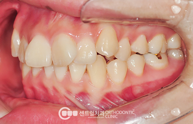 강남 급속교정 RS교정으로 치료 가능한 덧니 치열 상태 예시