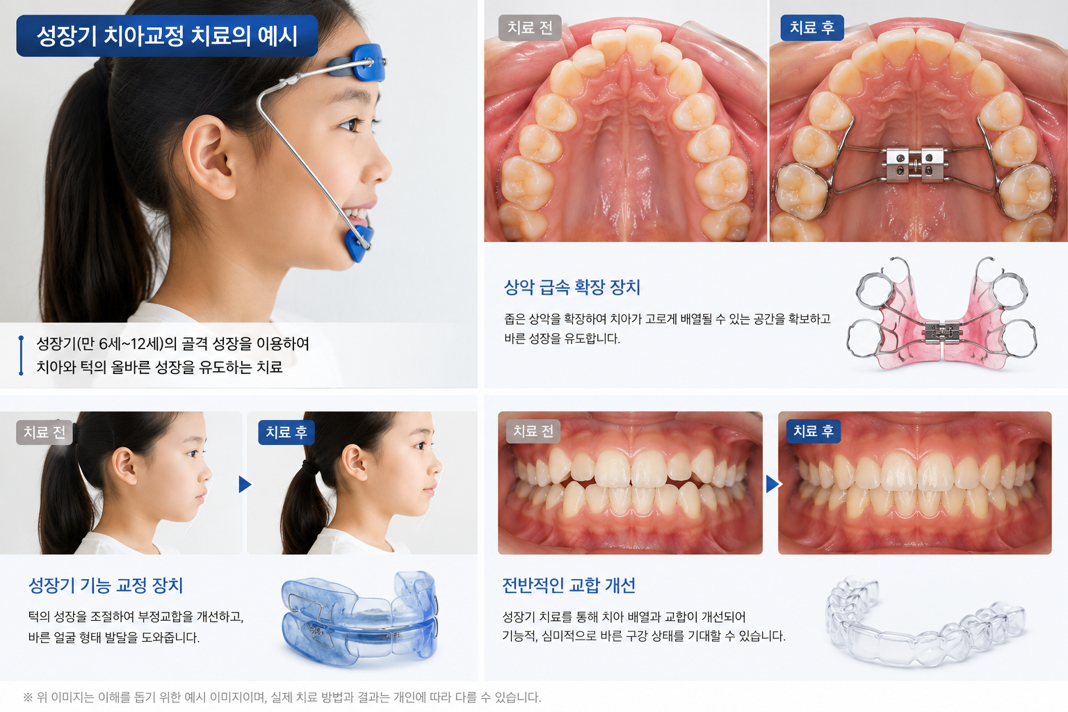 강남 성장기 교정 예시 — 아이의 골격 성장을 활용한 1차 교정 치료 과정