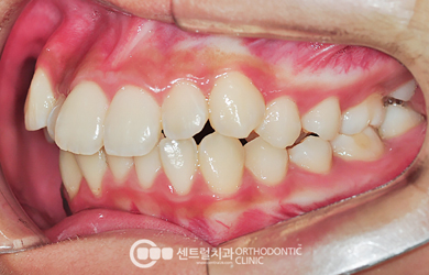 강남 급속교정 RS교정으로 치료하는 엉클어진 치아 교정 전 상태