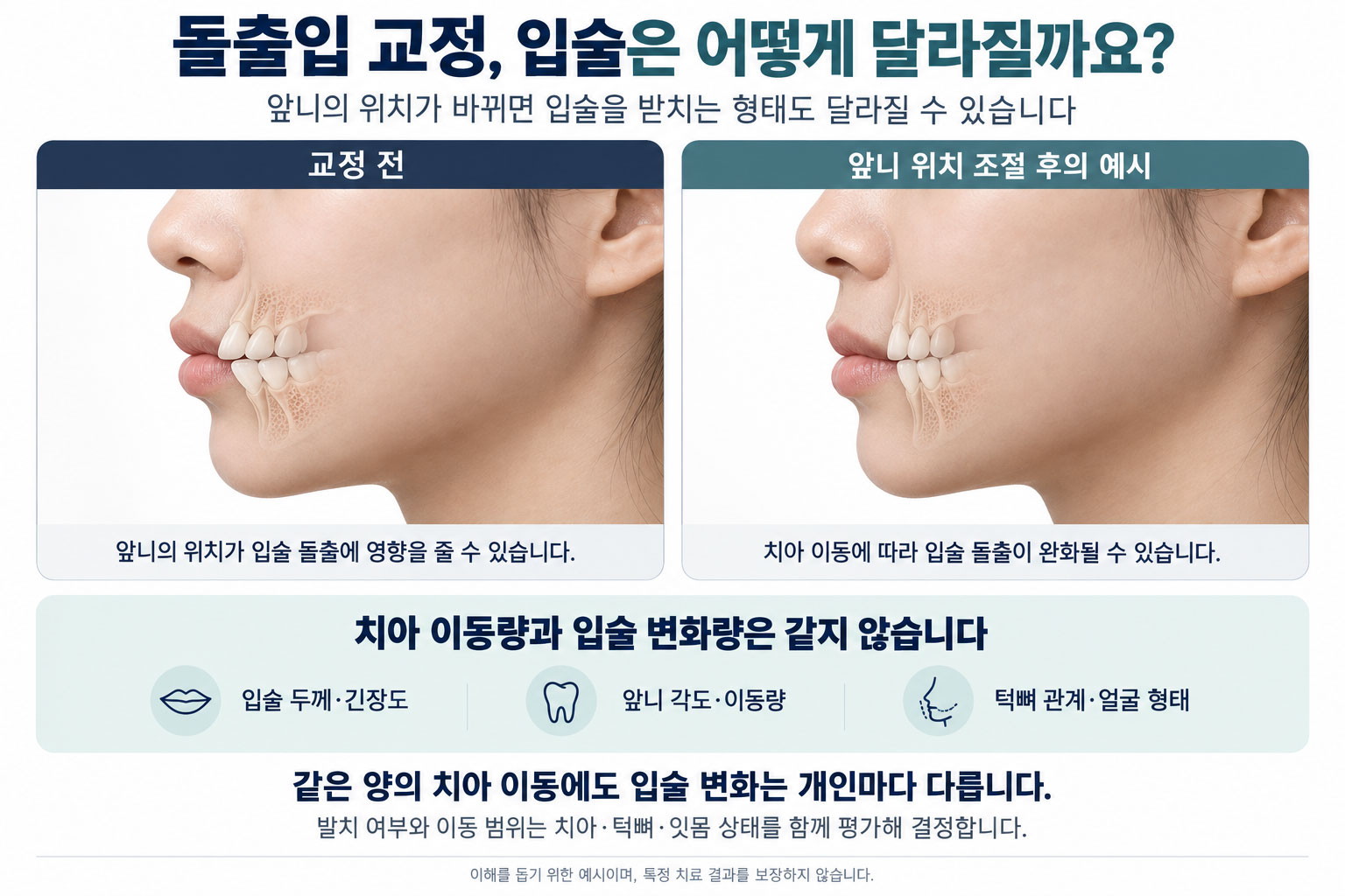 돌출입 교정 입술 변화 설명 — 치아 이동량과 입술 변화량이 1:1로 비례하지 않는 이유를 입술 두께·긴장도·골격 기준으로 정리한 강남 센트럴치과 안내 이미지